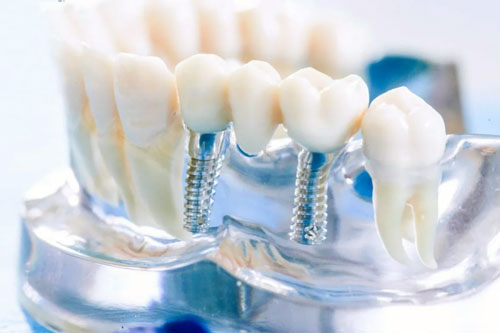 Подготовка к протезированию зубов: основные этапы